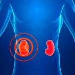 Гідронефроз нирки: симптоми, причини, лікування та ступені