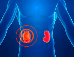 Гідронефроз нирки: симптоми, причини, лікування та ступені