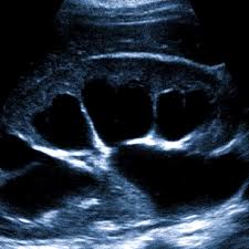 Гидронефроз почки: симптомы, причины, лечение и стадии